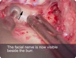 Facial Nerve